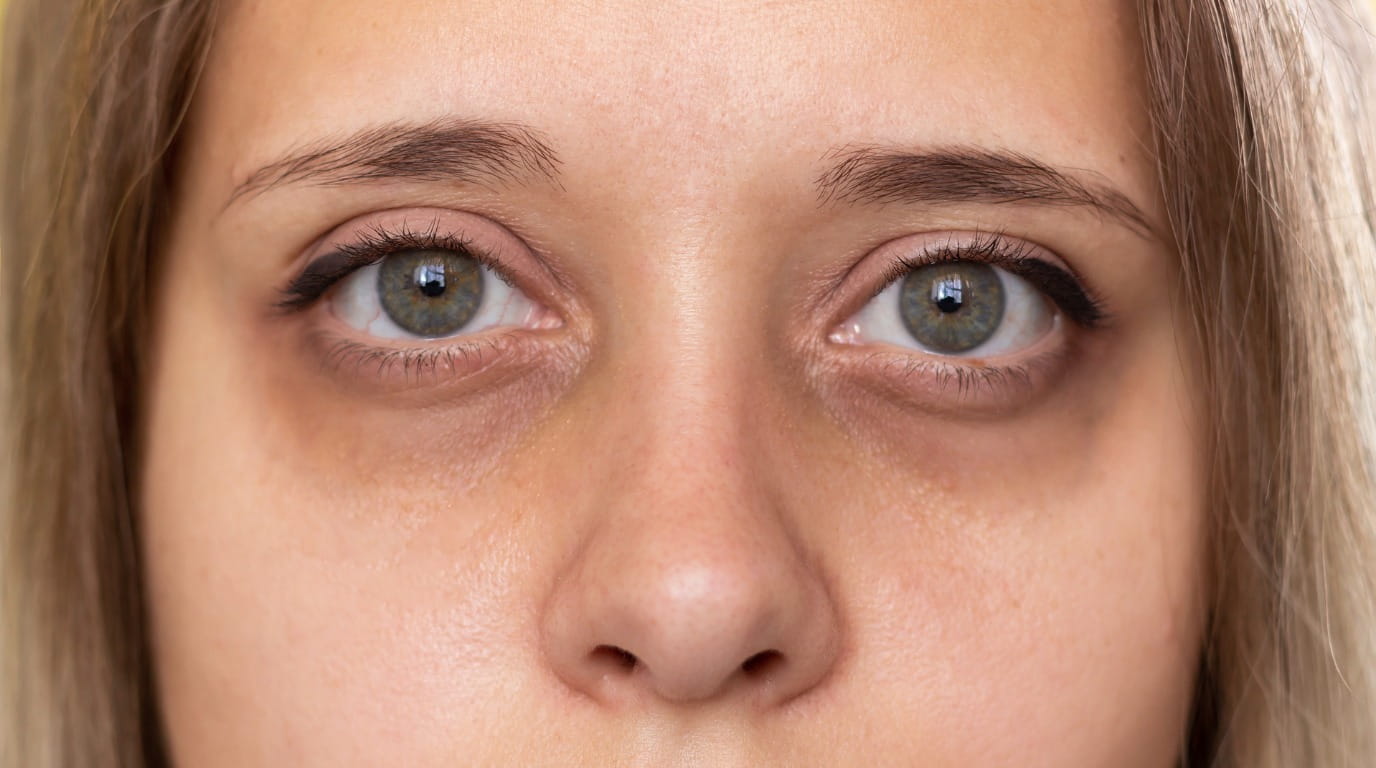 under-eye skin assessment in Dubai